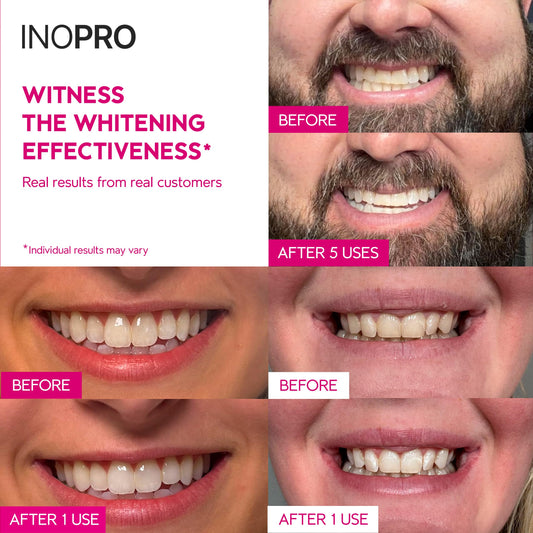 InoPro Teeth Whitening Strips – Peroxide-Free Whitening for Sensitive Teeth