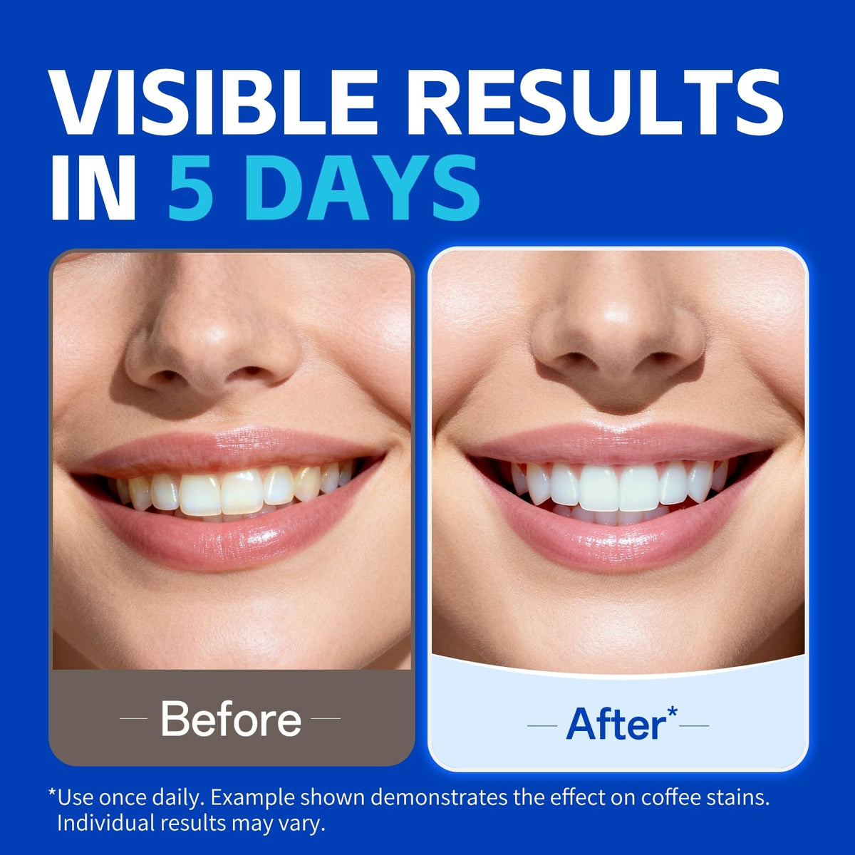 Professional Teeth Whitening Strips | PERSMAX 14-Day Treatment Kit